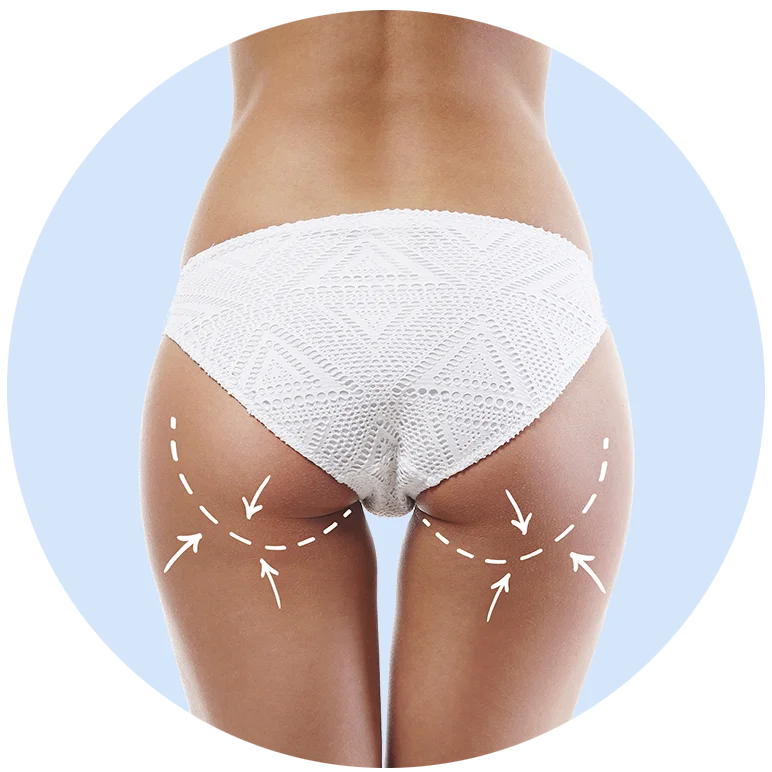 Zona de glúteos y muslos con líneas y flechas que indican reafirmación y remodelación corporal mediante aparatología estética no invasiva.