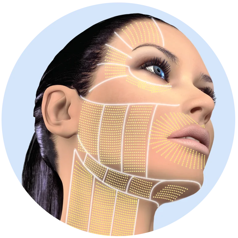 Female face with lines and dots indicating areas for facial treatment for firming and rejuvenation using aesthetic equipment.