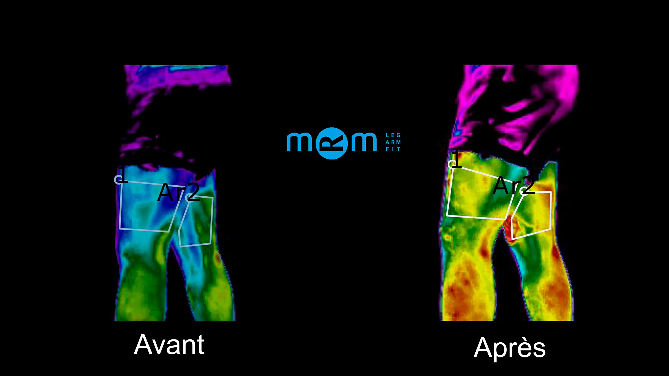 Image thermique comparative de la jambe avant et après le traitement, montrant une augmentation significative du flux sanguin avec une température plus élevée et une circulation améliorée.